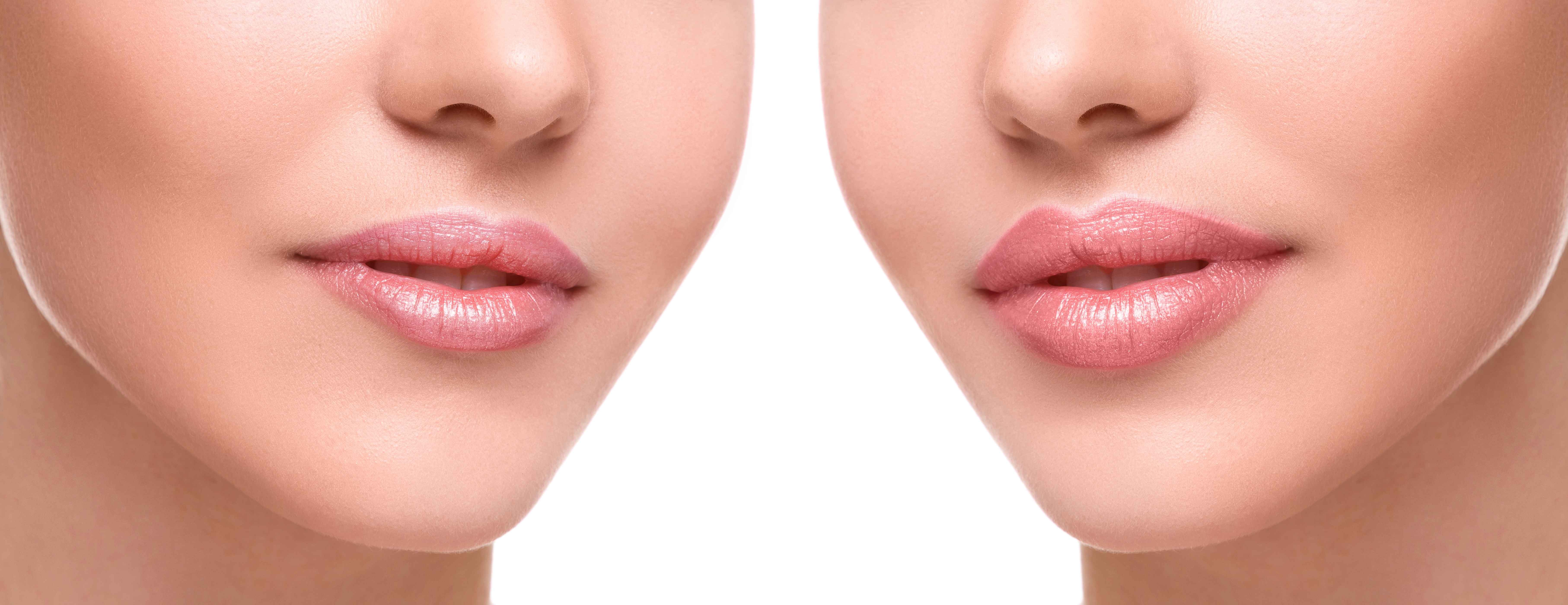Сделать форму губ. Красивые губы. Красивая контурная пластика губ. Красивая форма губ. Увеличенные губы красивые.